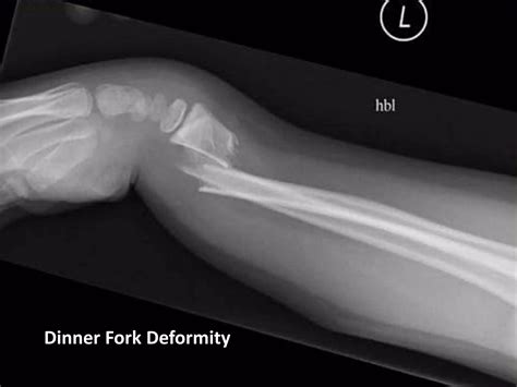 Distal End Radius Fractures - Colles, Smiths & Bartons | PPTX