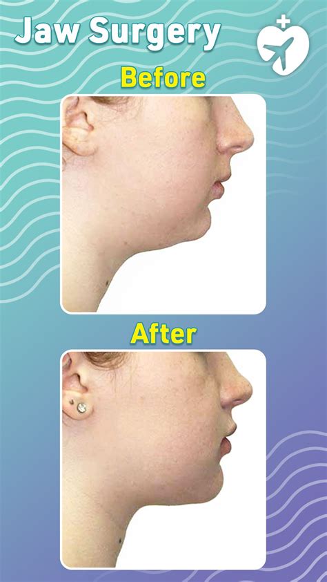 Jaw Surgery Before and after | Jaw surgery, Facial surgery, Surgery