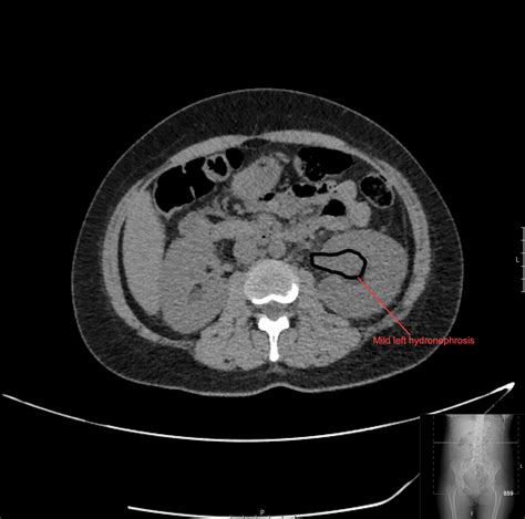 CT Case 067 • LITFL • CT scan interpretation