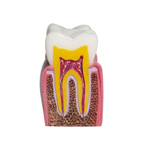 Buy 3ZH Triumph Model Dental Caries Tooth Model, 6 Times Decay Teeth ...