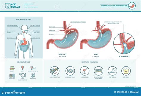 Does Acid Cause Heartburn at Mary Aplin blog
