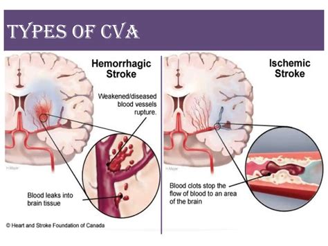 CVA - Cerebrovascular Accident / Stroke | PPTX