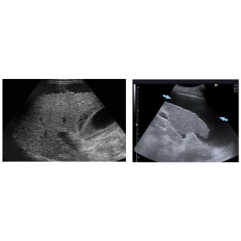 Daño Hepático Crónico: Hallazgos Ecográficos Importantes en Hepatopatía ...