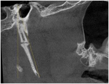 Image result for Styloid Process of Temporal Bone X-ray Positioning