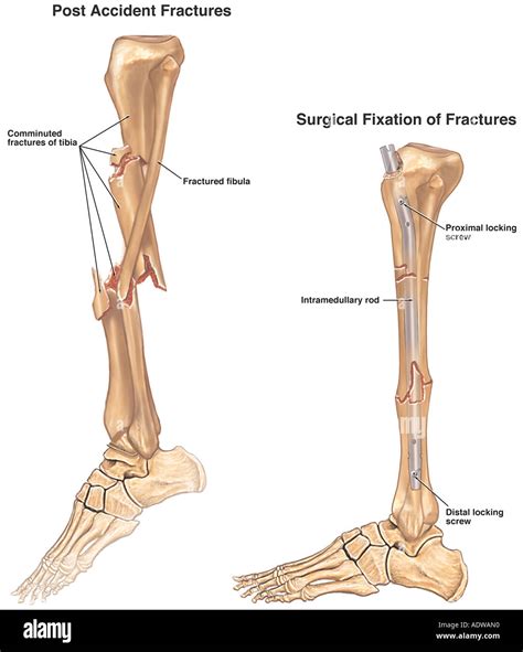 Image result for Open Fracture Surgery