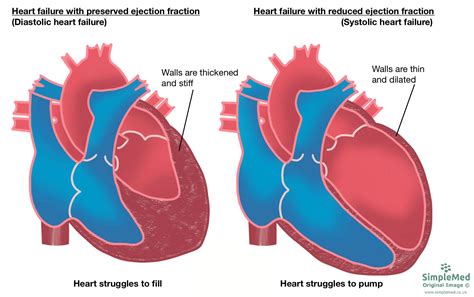 Diastolic Heart Failure