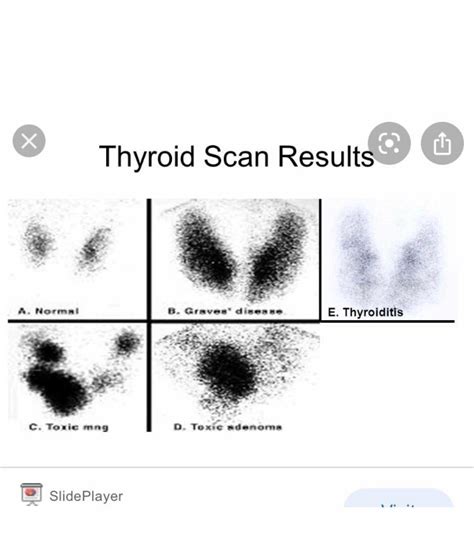Graves Disease Thyroid Scan