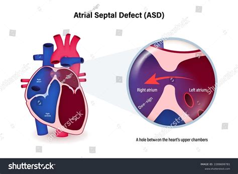 Atrial Septal Defect