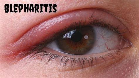 Bildergebnis für blepharitis hausmittel