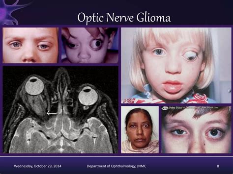 Optic nerve tumors ppt | PPTX
