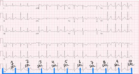 Quick Tip: How to Calculate Heart Rate in Atrial Fibrillation on ECG