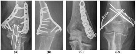 Risk Factors for Non-Union after Open Reduction and Internal Fixation ...
