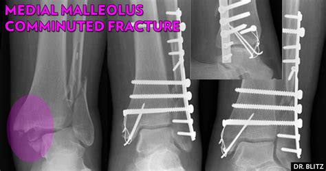 5 Kinds of Medial Malleolus Ankle Fractures