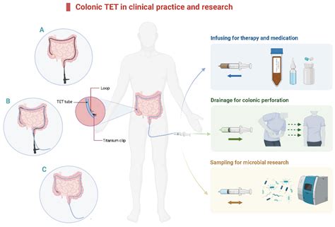 Colonic Transendoscopic Enteral Tubing Is a New Pathway to Microbial Therapy, Colonic Drainage ...