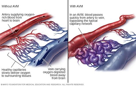 Brain AVM (arteriovenous malformation) - Symptoms and causes - Mayo Clinic
