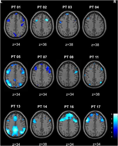 Image result for Dorsolateral Prefrontal Cortex