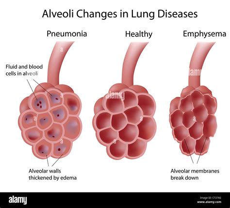 How Is Alveolar Gas Exchange Affected by Emphysema and Pneumonia