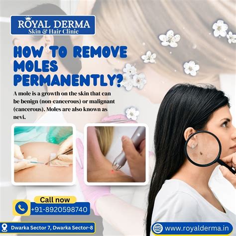 How to remove moles permanently?