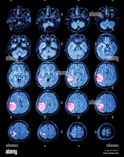 Mri brain tumor hi-res stock photography and images - Alamy