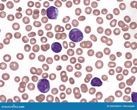 Primary Cutaneous Diffuse Large B-cell Lymphoma, Leg Type. Stock Photo - Image of hematology ...