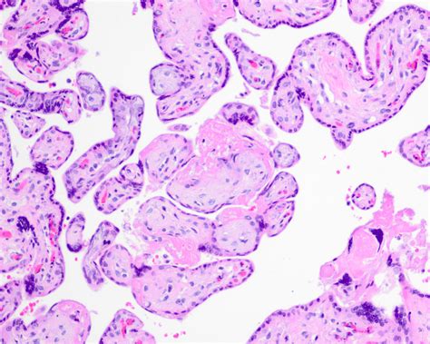 Pathology Outlines - Intrauterine fetal demise