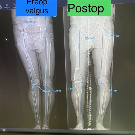Knock Knee Deformity Before and After Photos – Limb Lengthening