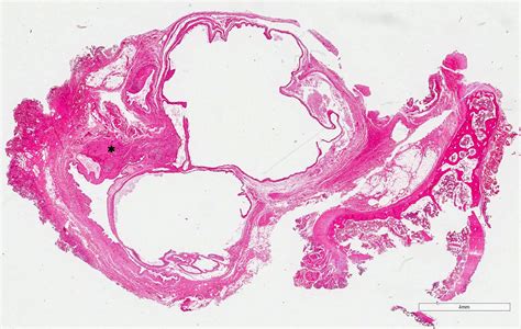 Thyroglossal Duct Cyst Histology Thyroglossal Duct Anomalies In