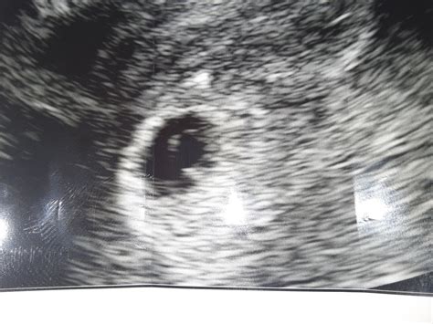 6Wks 0Days Ultrasound (No heartbeat or fetal pole) | BabyCenter