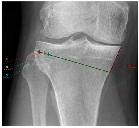 Influence of Medial Osteotomy Height and Hinge Position in Open Wedge ...