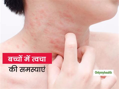 Symptoms And Causes Of Skin Disorder In Children In Hindi । बच्चों की ...