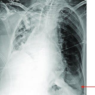 Sulcus Sign Explained 的图像结果
