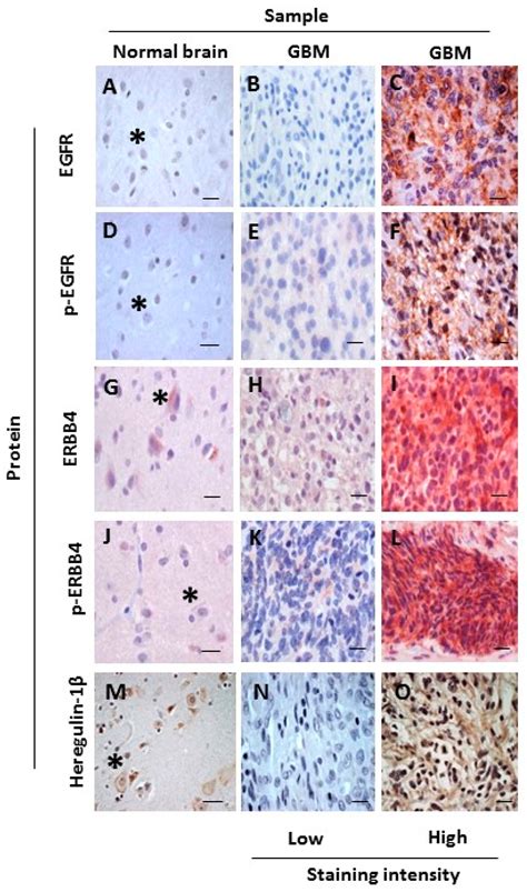 Activation of ERBB4 in Glioblastoma Can Contribute to Increased ...