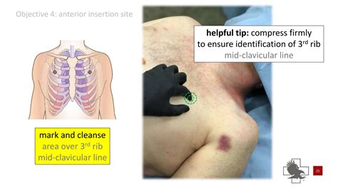 Power point of needle chest compressions | PPTX