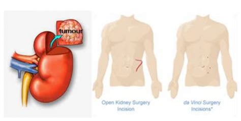 Image result for Steps of Partial Nephrectomy
