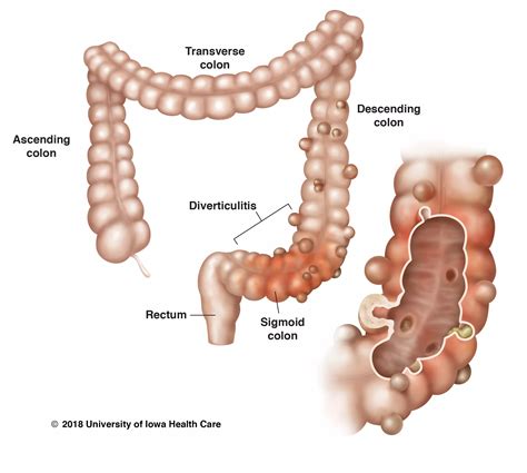 Diverticulitis Vs Diverticulosis