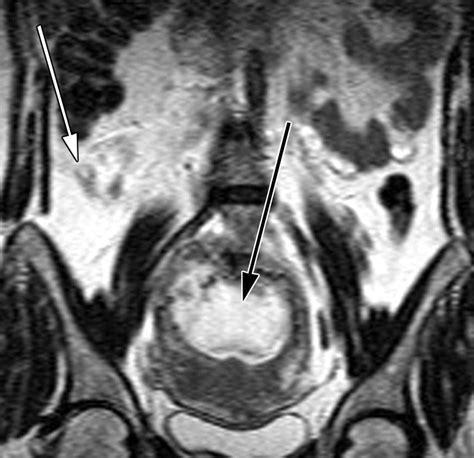 MRI for Clinically Suspected Appendicitis During Pregnancy | AJR
