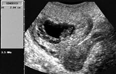 gestazionale senza embrione cause gestazionale senza embrione cause