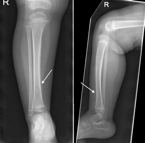 Tibia Fracture