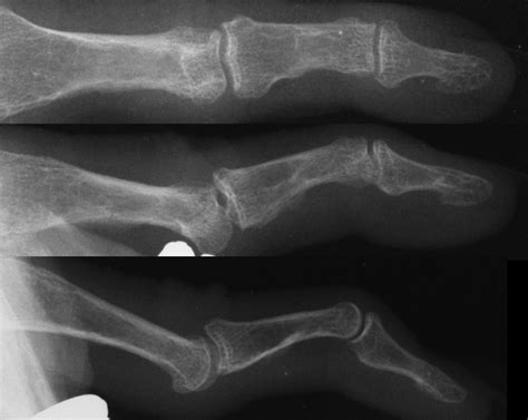 Image result for Hand Dysfunction