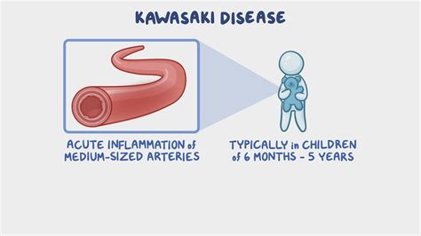 Kawasaki Disease