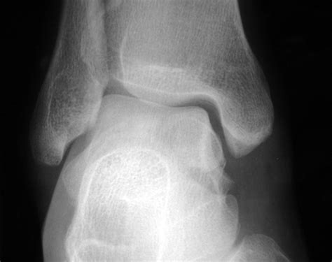 Comminuted fracture of the talus not visible on the initial radiograph ...