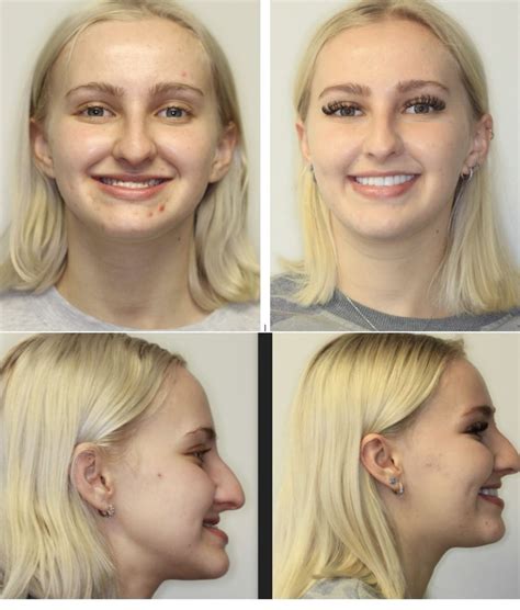 Double Jaw Surgery