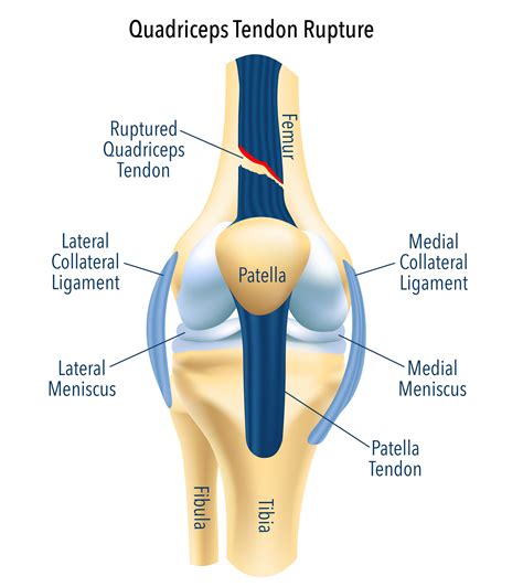 Quadriceps Tendon Rupture Treatment | Quadriceps Tendon Rupture Surgery