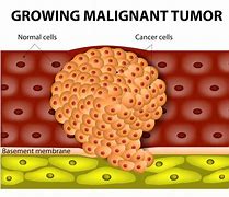 malignant tumor 的图像结果