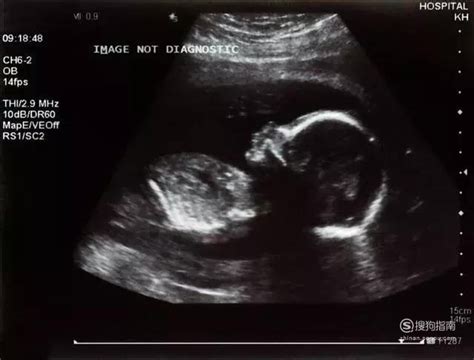 怀孕12周NT图片，不知道是否能看得出来男孩女孩前期怀孕6周胎囊是17*16*1 - 百度宝宝知道