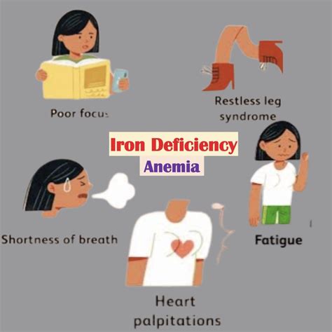 Iron-Deficiency Anemia Signs & Symptoms (ex. Fatigue, “Spoon Nails”, Cracked Lips)