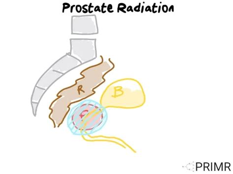Prostate Radiation Simulation 的图像结果