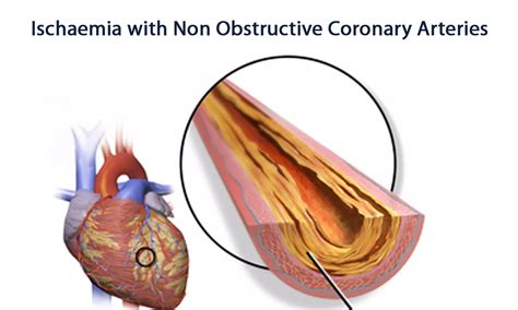Consensus Document on Ischaemia with Non-Obstructive Coronary Arteries ...