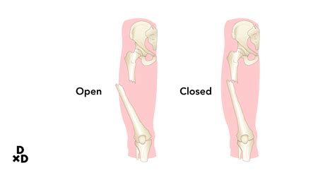 Open Vs Closed Fracture General Trauma, Management Of Polytrauma