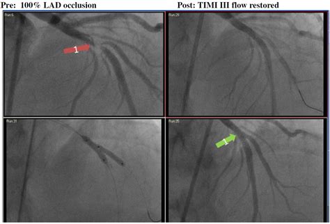 Image result for STEMI Cath Lab